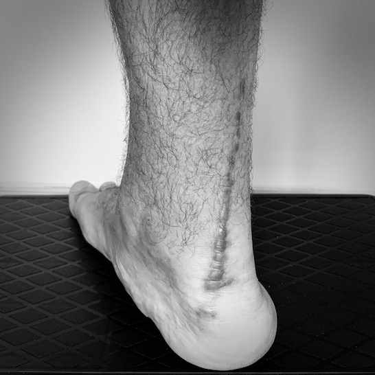 Scar of my Achilles tendon